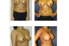 Breast-Augmentation