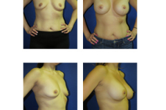 Breast-Augmentation New York City