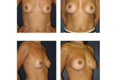 Breast Augmentation