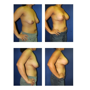 Breast-Lift-w-Augmentation-New-York-City-Patient-4-thumbnail