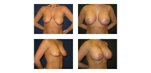 New-York-City-Breast-Lift-and-Implant-6