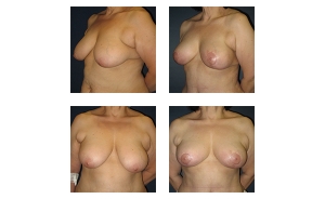 Breast-Lift-8