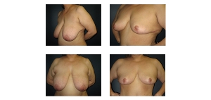 Breast-Lift-9