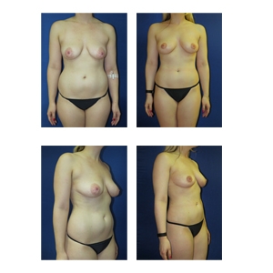 Breast-Lift-New-York-City-Patient-12-Thumbnail1