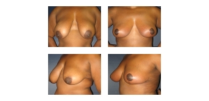 Breast-Reduction-101