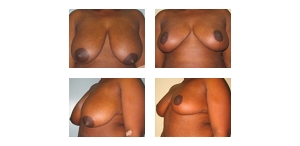 Breast-Reduction-21