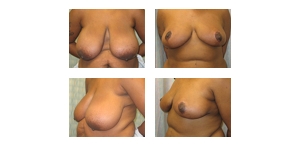 Breast-Reduction-32
