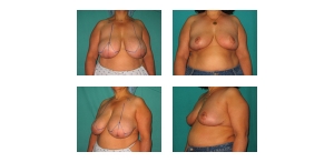 Breast-Reduction-61