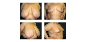 Breast-Reduction-71