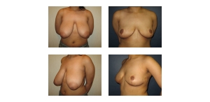 Breast-Reduction-81
