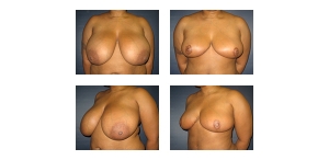 Breast-Reduction-91