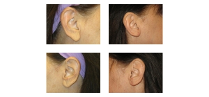 Earlobe-lift