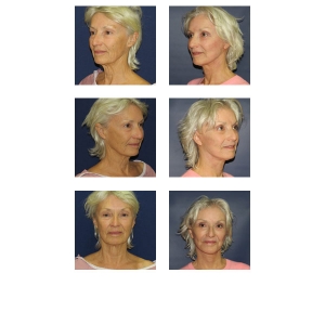 Facelift