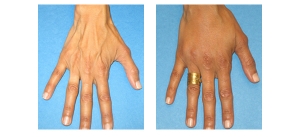 Hand-Rejuvenation