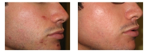 Laser-Acne-Removal-11