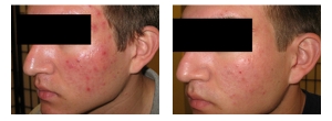 Laser-Acne-Removal-2