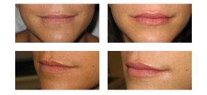 Lip-Injectables