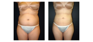 Liposuction-1