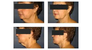 Liposuction-11