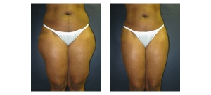 Liposuction-12