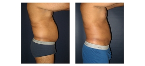Liposuction-14