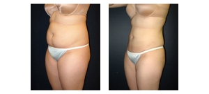 Liposuction-2