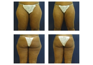 Liposuction-5