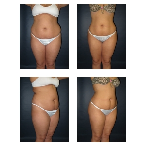 Liposuction-NYC