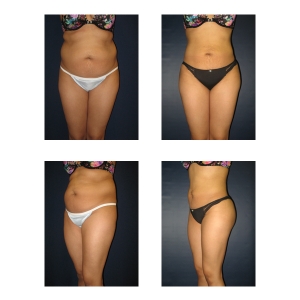Liposuction-NYC2