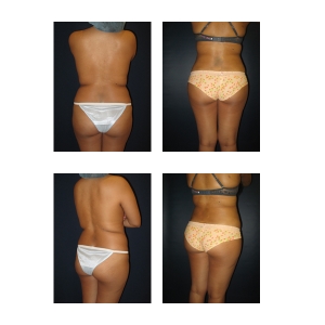 Liposuction-NYC6