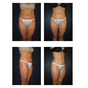 Liposuction-NYC7