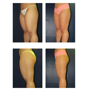 Liposuction-New-York-City-Thumb