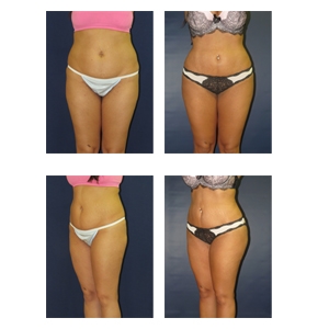 Liposuction-New-York-City-thumb-1