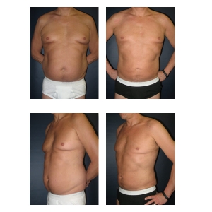 Liposuction-New-York-City