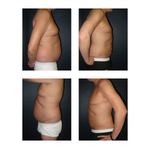 Liposuction-New-York-City1