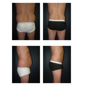 Liposuction-New-York-City2