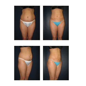 Liposuction-New-York-City3