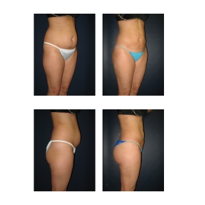 Liposuction-New-York-City4