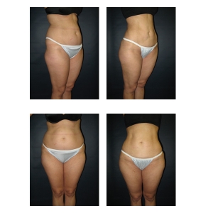 Liposuction-New-York-City5