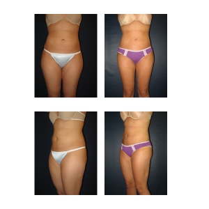 Liposuction-New-York