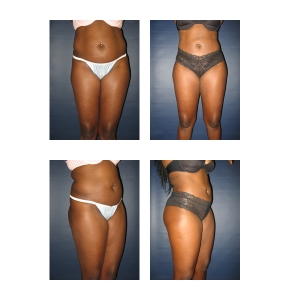 Liposuction-New-York1