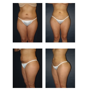 Liposuction-New-York2