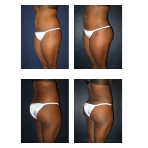 NYC-Liposuction