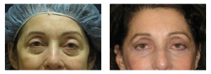 Lower-Eyelid