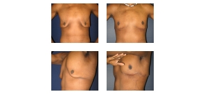 Male-Breast-Reduction-1