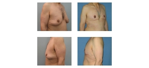 Male-Breast-Reduction-2