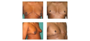 Male-Breast-Reduction-3