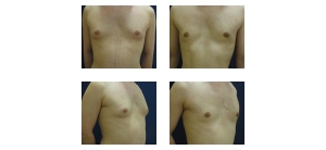 Male-Breast-Reduction-4