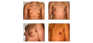 Male-Breast-Reduction-6