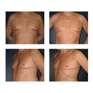 Male-Breast-Reduction